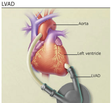 LVAD-transplant-in-india