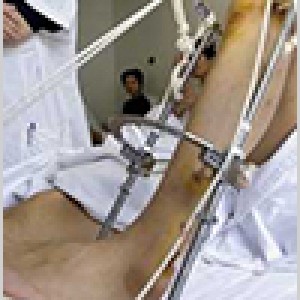 Limb-Lengthening-Height-Gain-Surgery