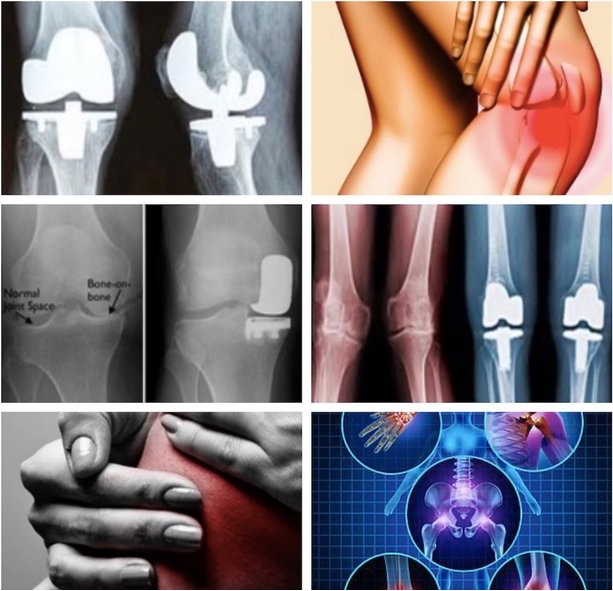 Partial-Knee-Replacement